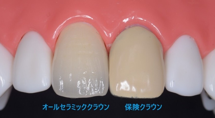 オールセラミッククラウンと保険クラウ�ンの違い