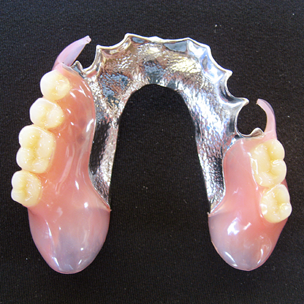 ノンクラスプデンチャー